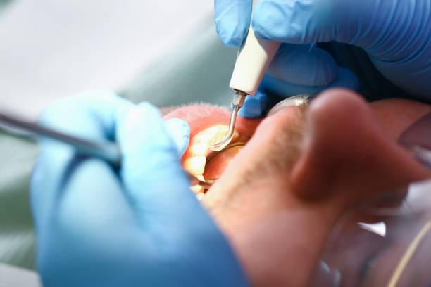 Best Emergency Wisdom Teeth Removal in The Plains, OH