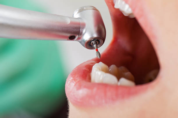 Best Emergency Tooth Extraction in The Plains, OH